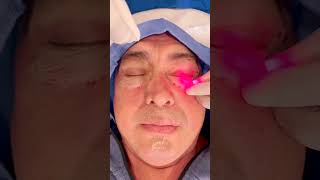 REMOVE FESTOONS and Malar BAGS With Endolift PCH MedSpa Dr Kaveh Karandish [upl. by Swanson]