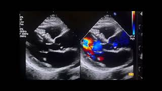 Rheumatic Mitral Valve Disease 🦠 Rheumatic heartcondition rheumaticheartdisease [upl. by Hajin373]