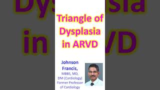 Triangle of Dysplasia in Arrhythmogenic Right Ventricular Dysplasia ARVD [upl. by Adyeren]