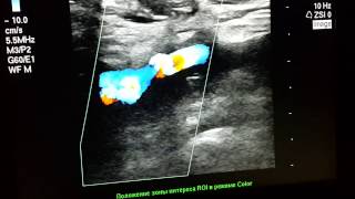 ultrasound MayThurner syndrome Deep vein iliofemoral trombosis [upl. by Kinom476]