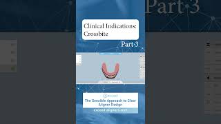 Clinical Indications Crossbite Part 3 [upl. by Cher]