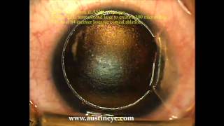 LASIK surgery explained stepbystep by Shannon Wong MD 122111 [upl. by Allemrac]