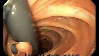 Right Colon Retroflexion [upl. by Clova]