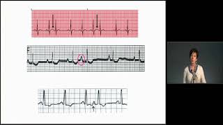 ECG Interpretation Atrial Rhythms  MEDED [upl. by Gearalt561]