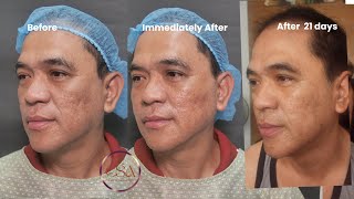 How to treat acne scars in a 50 yrold  Dr Contessa Salavador MD [upl. by Eenerb977]