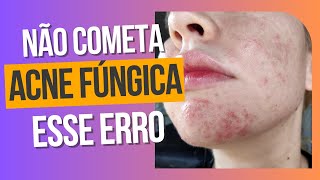 Escolhendo o melhor tratamento para acne fúngica  Comparação Peróxido de Benzoíla e Ácido Azelaico [upl. by Nomead318]