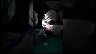 Mucocele cyst removal ytshorts maxillofacialsurgery doctor surgerycenter [upl. by Giuseppe]