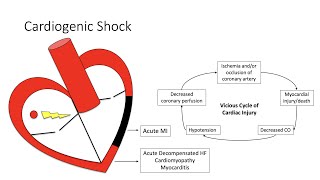 Cardiogenic Shock [upl. by Eissed543]