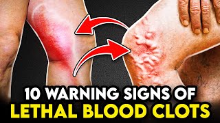 10 WARNING Signs of LETHAL Blood Clots or Deep Vein Thrombosis in Your Legs [upl. by Segroeg794]