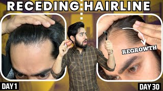 सिर्फ 1 महीने मैं RECEDING HAIRLINE REGROW करो  30 days HAIRLINE REGROWTH challenge [upl. by Aslin]