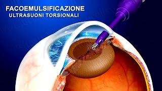 Cataratta terapia chirurgica con ultrasuoni torsionali wwwoculisticaTVit [upl. by Eserehs800]