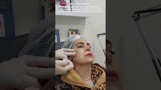 PROFHILO  Lower facelift without surgery  BAP technique demonstration lift tightness hydration [upl. by Siramed]