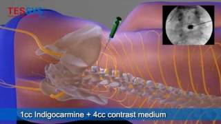 Treatment of herniated disc with TESSYS method lateral  BandscheibenOP mit TESSYSMethode lateral [upl. by Ahtennek]