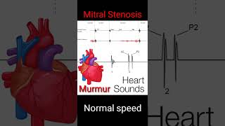 Normal Heart sounds and murmur Auscultation mitral valve stenosis murmur of heart in diastole [upl. by Ettevey]