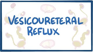 Vesicoureteral reflux  causes symptoms diagnosis treatment pathology [upl. by Else]