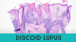 Discoid Lupus Erythematosus under the microscope pathology dermatology dermpath [upl. by Ahseihs]