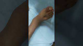 Pitting edema  DCLD patient clinicalexamination hospital doctor [upl. by Icyac]