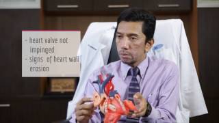 WHAT IS ATRIAL SEPTAL DEFECT ASD [upl. by Miksen832]