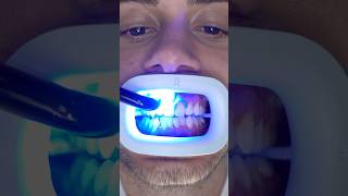 Transformation of Yellow Teeth teethwhitening [upl. by Anrev569]