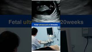 Fetal ultrasound at 20weeks ultrasound fetus babyboy babygirl fyp baby [upl. by Nanon]