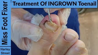 Cleaning and Cutting out an ingrown nail by miss foot fixer marion yau [upl. by Acinoreb416]