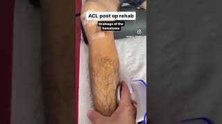 ⚡️ ACL Post Op Rehabilitation with Winback TECAR  HiTENS  HiEMS 🩹 [upl. by Dow518]