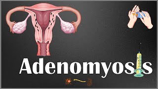 Adenomyosis  Definition Causes Risk Factors Signs amp Symptoms Diagnosis amp Treatment [upl. by Eileen]