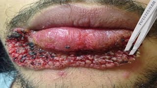 Worst Lip Pimples on YouTube [upl. by Rebmak]