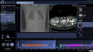 Pulmonary Angio Triger and start  radiology ctscan angiogram [upl. by Eelreveb]