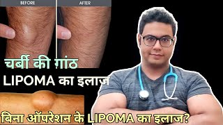 Doctor Explains Lipoma  Treatment without surgery and with surgery । LIPOMA का इलाज बिना ऑपरेशन के [upl. by Luz]