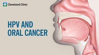 What Is HPVRelated Oral Cancer [upl. by Narton317]