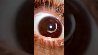 Eye drop Trend TikTok on Keratoconus [upl. by Euhc]