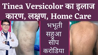 Tinea Versicolar Treatment  भभूतीसीपसहुआकरोडिया का इलाज  Pityriasis Versicolor  In Hindi [upl. by Diann]