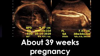 Practical ultrasound case  About 39 weeks pregnancy [upl. by Areit]