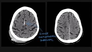 Understanding the different types of traumatic brain bleed on CT scans [upl. by Analiese734]