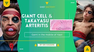 Large vessels vasculitis  Pathology  Visual Mnemonics  Crack NEET PG  USMLE PLAB [upl. by Esor210]