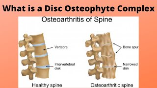 What is a Disc Osteophyte Complex [upl. by Endaira]