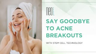 Say Goodbye to Acne Breakouts with Stem Cell Technology [upl. by Winson480]