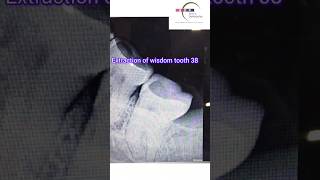 Painless EXTRACTION of Wisdom Tooth bhatiadentopulse toothpain extraction [upl. by Drofliw650]