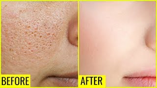 How to Get Rid of Large OPEN PORES Permanently  Anaysa [upl. by Ylirama812]