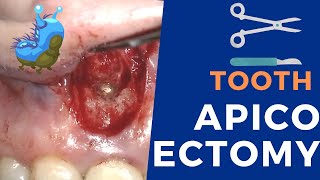 Apicoectomy surgery  Live procedure step by step [upl. by Charlet]