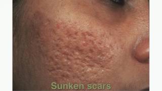 HOW TO GET RID OF ACNE SCARS [upl. by Innes678]