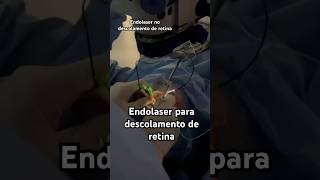 Vitrectomia com endolaser para descolamento de retina [upl. by Anida838]