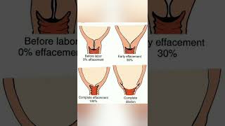 Before and after labor 🤰 dilatation of cervix knowledge easylearning medico shortsvideo share [upl. by Enuj957]