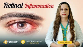 Retinal Inflammation  Clinical Ophthalmology Video  VLearning  sqadiacom [upl. by Eiramlehcar]