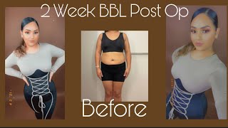 BBL 2 Week Post Op Update  Body Reveal  BBL Arm and Chin Lipo  305 plastic Surgery [upl. by Eastman]