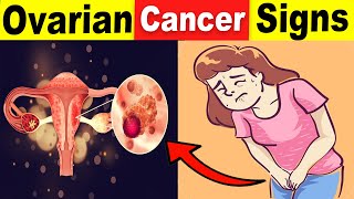 9 Common Ovarian Cancer Signs That You Should Never Ignore [upl. by Bencion327]