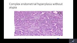 Endometrial hyperplasia Dr M Ramadan [upl. by Casia]