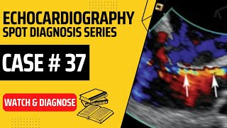 Echo Case 37 Echocardiography Spot Diagnosis Series  Learn Echo with Labelled findings [upl. by Enaujed]