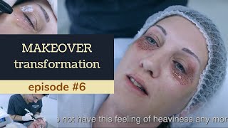 EYE LIFT PLEXR Makeover transformation Ep 6 [upl. by Yorgen]